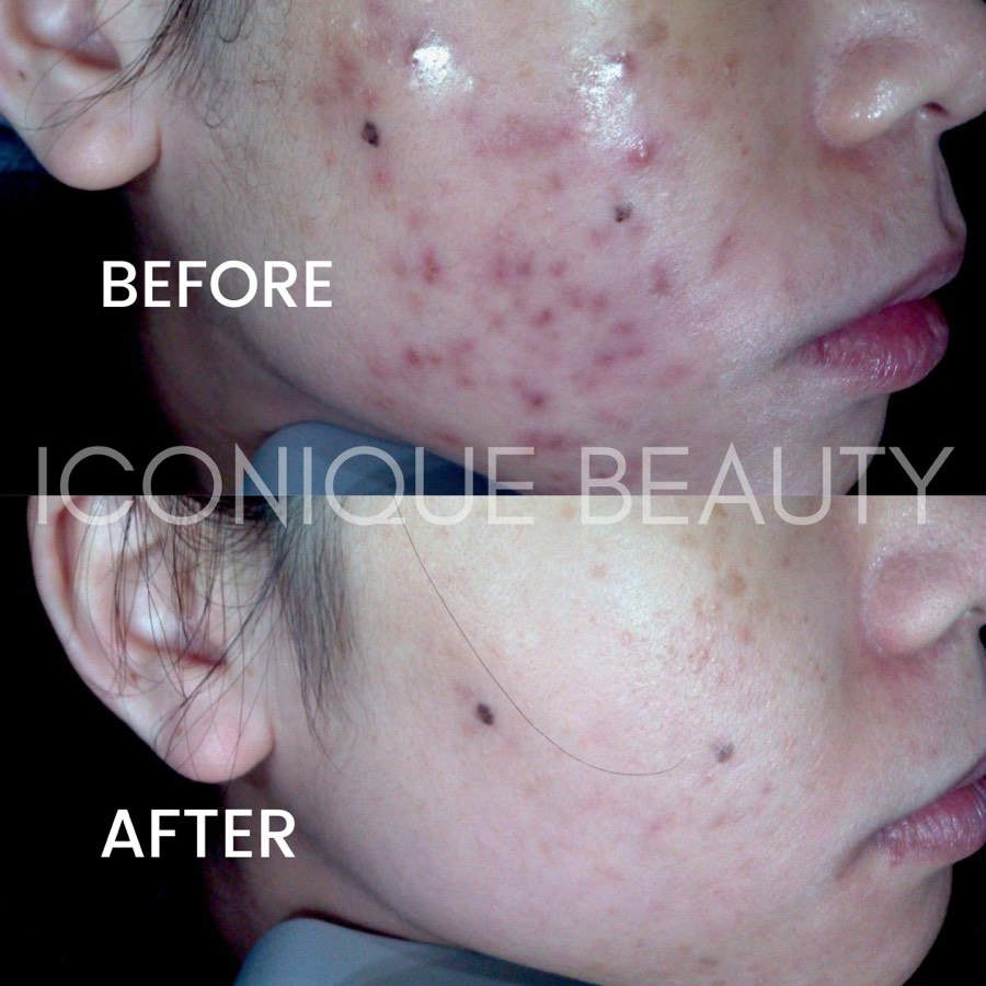 Before and after: dense inflamed breakouts on the cheek, settled and flat afterwards.