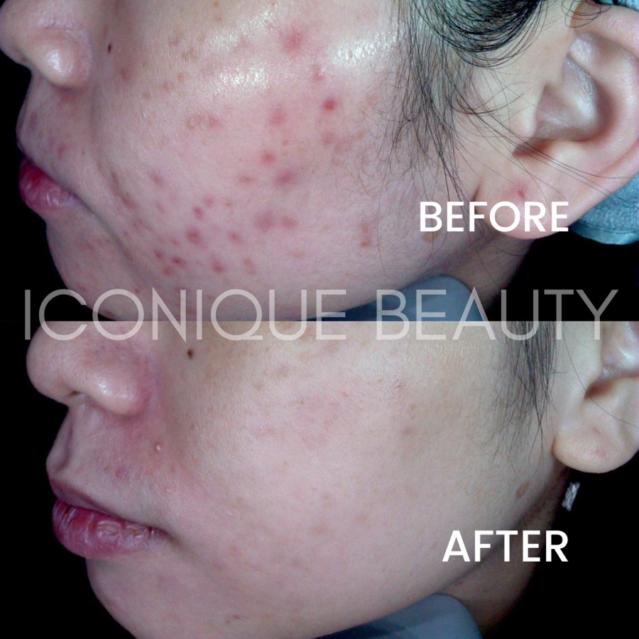 Before and after: red raised spots and marks along the cheek and jaw, calmer afterwards.