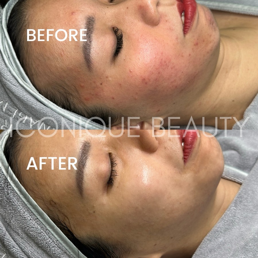 Before and after: inflammation and redness across the cheek and jaw, settled afterwards.