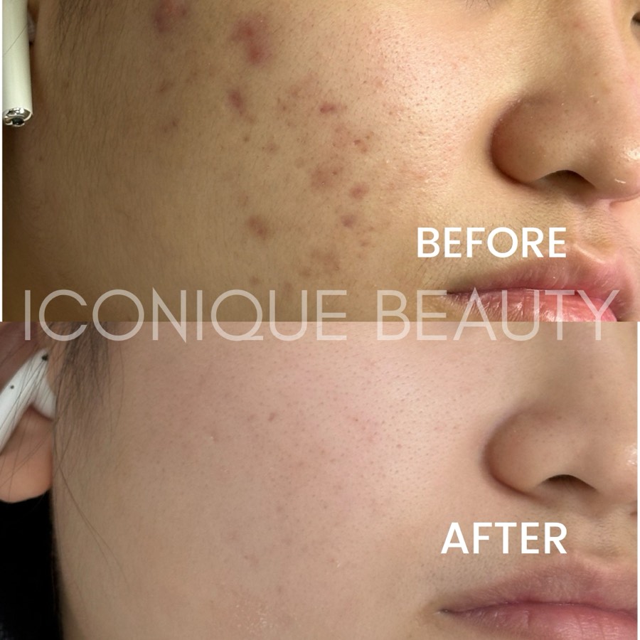 Before and after: brown and red marks on the cheek, faded afterwards.