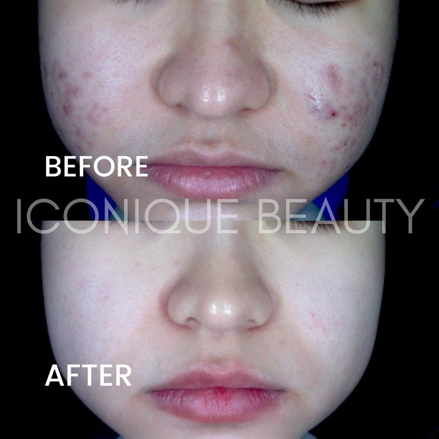 Before and after: breakouts across both cheeks, much clearer afterwards.