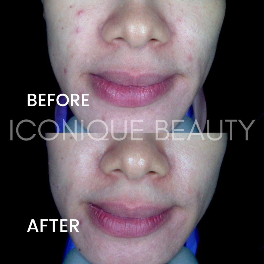 Before and after: small breakouts around the chin and mouth, cleared afterwards.