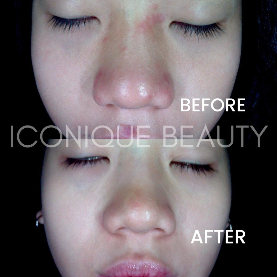 Before and after: redness around the nose and brow, calmed afterwards.