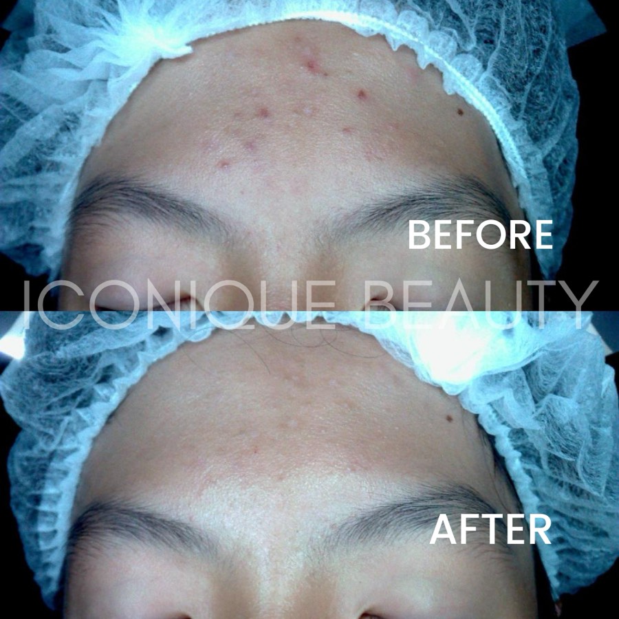 Before and after: breakouts across the forehead, cleared afterwards.