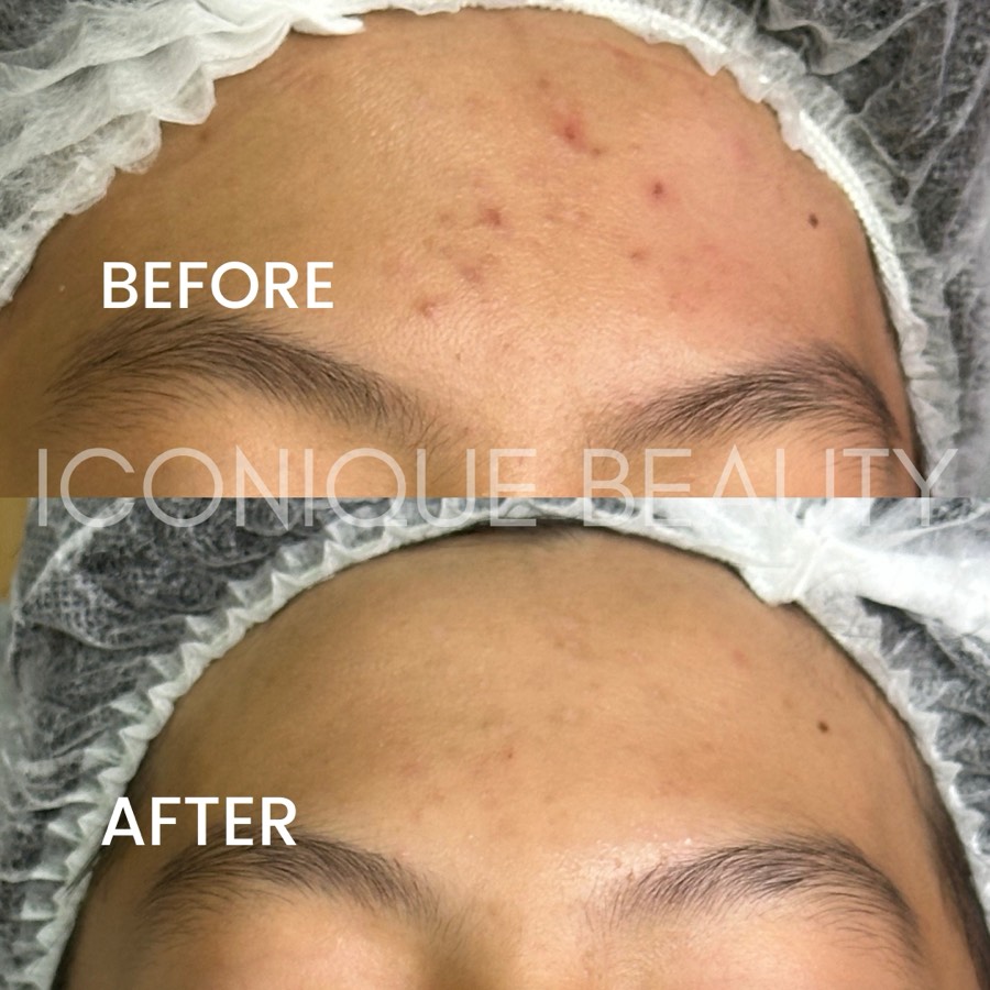 Before and after: raised spots on the forehead, settled afterwards.