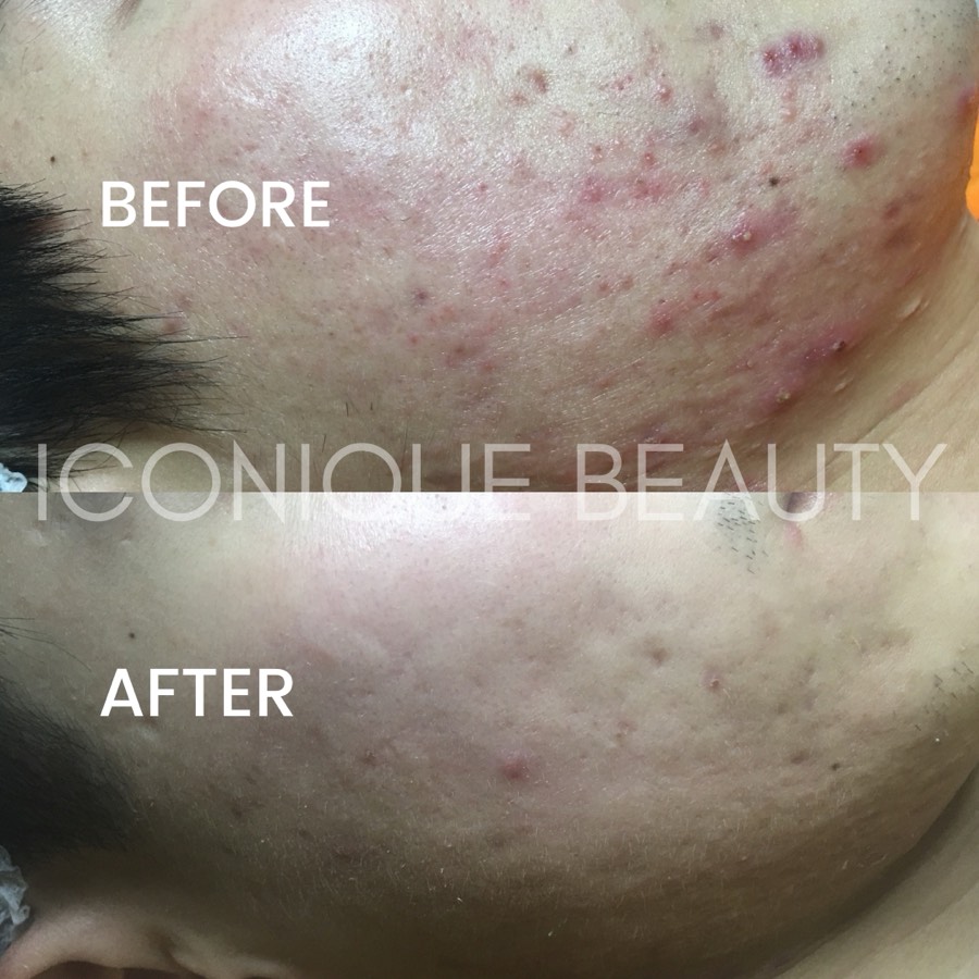 Before and after: heavy inflammation along the jaw, considerably calmer afterwards.