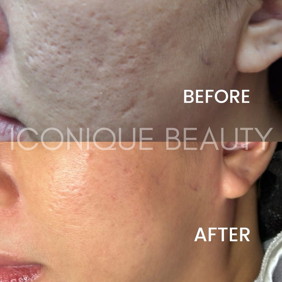 Before and after: uneven texture on the cheek, smoother afterwards.