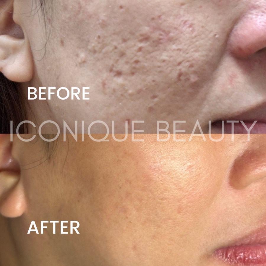 Before and after: pitted texture across the cheek, smoother afterwards.